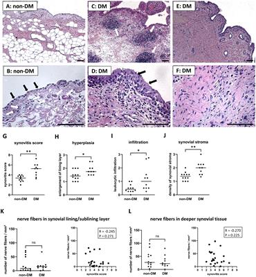 Enhanced joint pain in diabetic patients with knee osteoarthritis is associated with increased synovitis, synovial immune cell infiltration, and erythrocyte extravasation